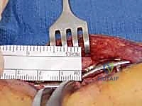 أعراض آلام الكاحل وتشوهاته