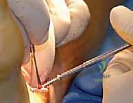 التشخيص الدقيق بالأشعة لتشوهات الكاحل