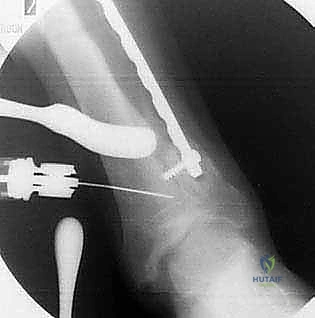 الأستاذ الدكتور محمد هطيف رائد جراحة العظام في اليمن