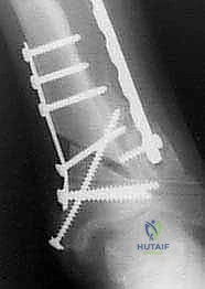 استعادة القدرة على المشي الطبيعي