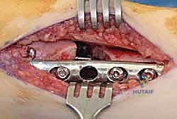 العلاج الطبيعي والتأهيل بعد الجراحة