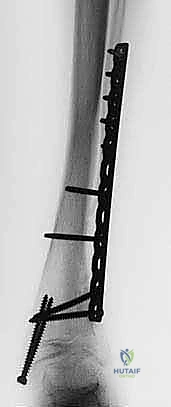 صورة توضيحية لـ قطع عظم الساق فوق الكاحل: الحل الأمثل لتشوهات الكاحل المعقدة مع الأستاذ الدكتور محمد هطيف