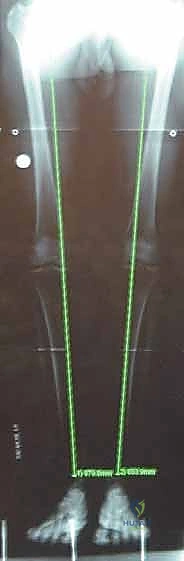 أسباب تلف الغضروف المفصلي في الركبة