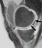 تشخيص إصابات الغضروف بواسطة الرنين المغناطيسي