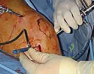 مبدأ عمل الوخز المجهري لتحفيز نخاع العظم