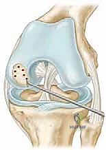صورة توضيحية لـ تجميل الغضروف بالوخز المجهري استعادة مرونة الركبة تحت إشراف الأستاذ الدكتور محمد هطيف