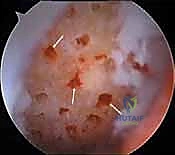 صورة توضيحية لـ تجميل الغضروف بالوخز المجهري استعادة مرونة الركبة تحت إشراف الأستاذ الدكتور محمد هطيف