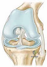 Illustration of microfracture chondroplasty microfracture - Dr. Mohammed Hutaif