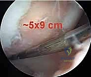 صورة طبية: تجميل الغضروف بالوخز المجهري استعادة مرونة الركبة تحت إشراف الأستاذ الدكتور محمد هطيف