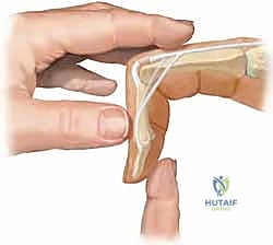 أساليب العلاج التحفظي والتجبير الديناميكي