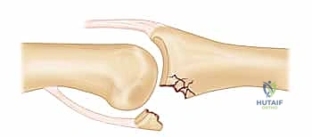 خطوات تقنية رأب الصفيحة الراحية VPA