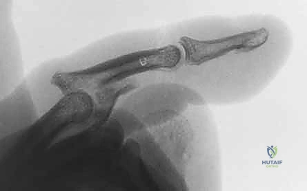 تقنية الرد المفتوح والتثبيت الداخلي بالمسامير الدقيقة