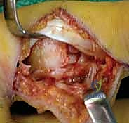 صورة طبية: كسر خلع مفصل الإصبع الأوسط (PIP): دليل شامل للتشخيص والعلاج الجراحي مع الأستاذ الدكتور محمد هطيف