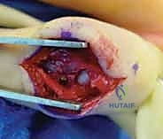 صورة توضيحية لـ كسر خلع مفصل الإصبع الأوسط (PIP): دليل شامل للتشخيص والعلاج الجراحي مع الأستاذ الدكتور محمد هطيف