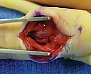 صورة توضيحية لـ كسر خلع مفصل الإصبع الأوسط (PIP): دليل شامل للتشخيص والعلاج الجراحي مع الأستاذ الدكتور محمد هطيف