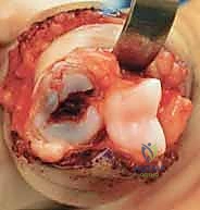 صورة طبية: كسر خلع مفصل الإصبع الأوسط (PIP): دليل شامل للتشخيص والعلاج الجراحي مع الأستاذ الدكتور محمد هطيف