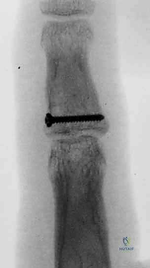 صورة طبية: كسر خلع مفصل الإصبع الأوسط (PIP): دليل شامل للتشخيص والعلاج الجراحي مع الأستاذ الدكتور محمد هطيف