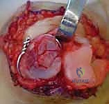 صورة توضيحية لـ كسر خلع مفصل الإصبع الأوسط (PIP): دليل شامل للتشخيص والعلاج الجراحي مع الأستاذ الدكتور محمد هطيف