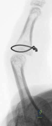 صورة طبية: كسر خلع مفصل الإصبع الأوسط (PIP): دليل شامل للتشخيص والعلاج الجراحي مع الأستاذ الدكتور محمد هطيف