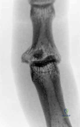 صورة طبية: كسر خلع مفصل الإصبع الأوسط (PIP): دليل شامل للتشخيص والعلاج الجراحي مع الأستاذ الدكتور محمد هطيف