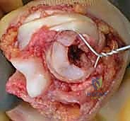 PIP Joint Fracture-Dislocation ORIF: An Intraoperative Masterclass