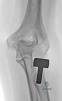 التأكد من استقرار المفصل قبل التثبيت النهائي