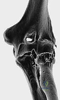 النهج الجراحي الدقيق للكوع