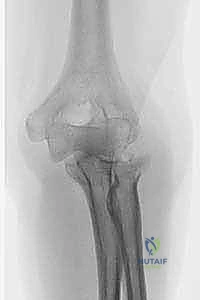 تنظيف المفصل وتجهيزه للغرسة