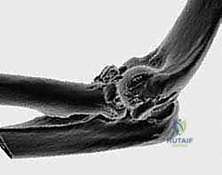 الأشعة السينية لكسر معقد في رأس الكعبرة