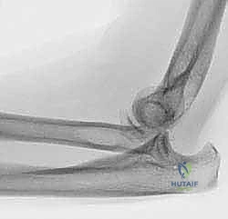 جراحة استبدال رأس الكعبرة المعيارية: حل مبتكر لإصابات الكوع المعقدة مع الأستاذ الدكتور محمد هطيف