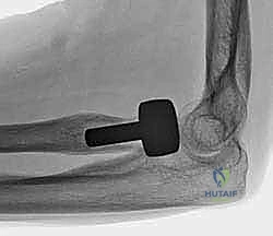 صورة طبية: جراحة استبدال رأس الكعبرة المعيارية: حل مبتكر لإصابات الكوع المعقدة مع الأستاذ الدكتور محمد هطيف