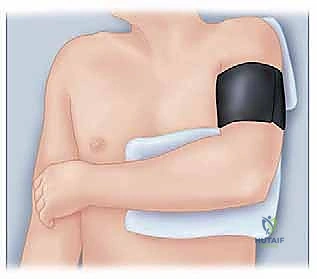 صورة طبية: جراحة استبدال رأس الكعبرة المعيارية: حل مبتكر لإصابات الكوع المعقدة مع الأستاذ الدكتور محمد هطيف
