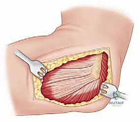 صورة طبية: جراحة استبدال رأس الكعبرة المعيارية: حل مبتكر لإصابات الكوع المعقدة مع الأستاذ الدكتور محمد هطيف