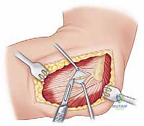 صورة طبية: جراحة استبدال رأس الكعبرة المعيارية: حل مبتكر لإصابات الكوع المعقدة مع الأستاذ الدكتور محمد هطيف