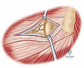 صورة طبية: جراحة استبدال رأس الكعبرة المعيارية: حل مبتكر لإصابات الكوع المعقدة مع الأستاذ الدكتور محمد هطيف