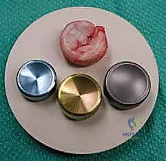 صورة طبية: جراحة استبدال رأس الكعبرة المعيارية: حل مبتكر لإصابات الكوع المعقدة مع الأستاذ الدكتور محمد هطيف