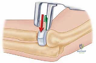 صورة طبية: جراحة استبدال رأس الكعبرة المعيارية: حل مبتكر لإصابات الكوع المعقدة مع الأستاذ الدكتور محمد هطيف
