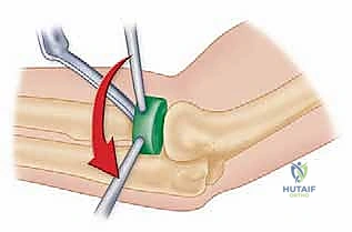 صورة طبية: جراحة استبدال رأس الكعبرة المعيارية: حل مبتكر لإصابات الكوع المعقدة مع الأستاذ الدكتور محمد هطيف