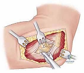 صورة توضيحية لـ جراحة استبدال رأس الكعبرة المعيارية: حل مبتكر لإصابات الكوع المعقدة مع الأستاذ الدكتور محمد هطيف