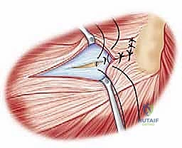 صورة توضيحية لـ جراحة استبدال رأس الكعبرة المعيارية: حل مبتكر لإصابات الكوع المعقدة مع الأستاذ الدكتور محمد هطيف