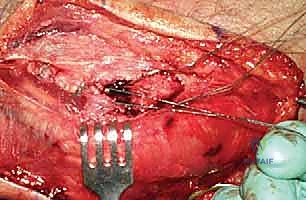 صورة توضيحية لـ جراحة استبدال رأس الكعبرة المعيارية: حل مبتكر لإصابات الكوع المعقدة مع الأستاذ الدكتور محمد هطيف