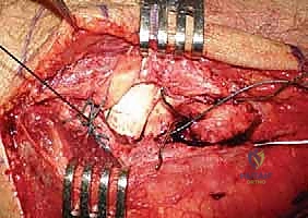 صورة طبية: جراحة استبدال رأس الكعبرة المعيارية: حل مبتكر لإصابات الكوع المعقدة مع الأستاذ الدكتور محمد هطيف