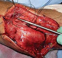 صورة توضيحية لـ جراحة استبدال رأس الكعبرة المعيارية: حل مبتكر لإصابات الكوع المعقدة مع الأستاذ الدكتور محمد هطيف