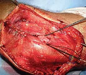 صورة طبية: جراحة استبدال رأس الكعبرة المعيارية: حل مبتكر لإصابات الكوع المعقدة مع الأستاذ الدكتور محمد هطيف