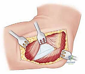 Illustration of radial head arthroplasty - Dr. Mohammed Hutaif