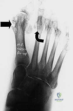 بروز عظام المشط وتقرحات باطن القدم