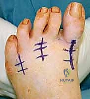 انحراف أصابع القدم وتراكبها