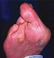 تآكل الغضاريف والمفاصل في القدم