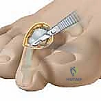 الحقن الموضعي لتخفيف الألم