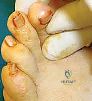 استخدام الأحذية الطبية والدعامات